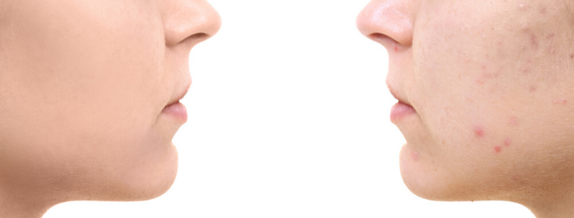 Does Marijuana Cause Acne Does Marijuana Cause Acne